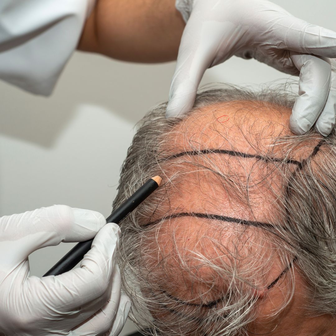 hair replacement surgery