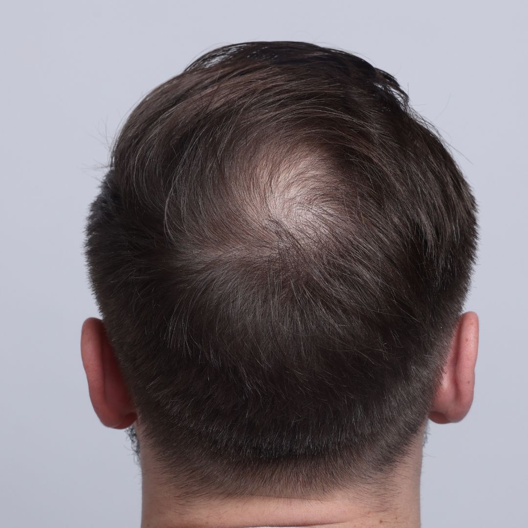neograft (1)