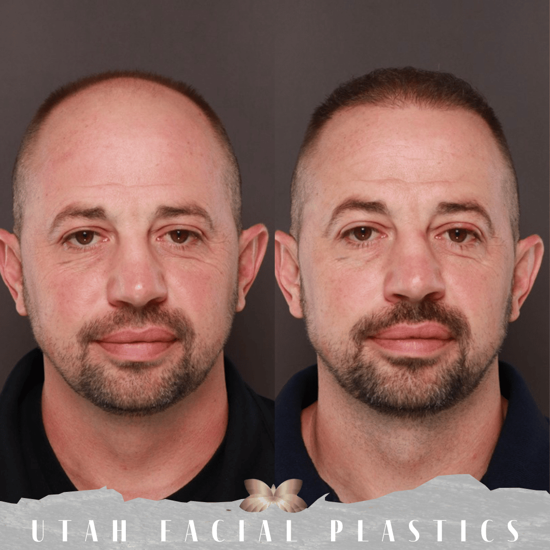 The Cost of Hair Transplant Surgery at Utah Facial Plastics SLC, Utah