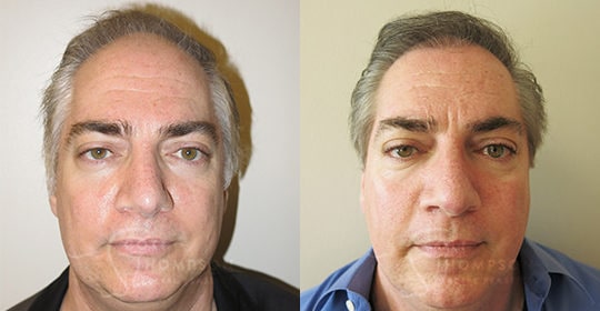 two close up headshot before and after photos of middle aged hair after receiving hair transplant