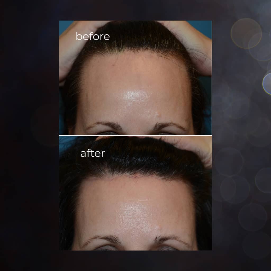 forehead reduction, lowering the hairline