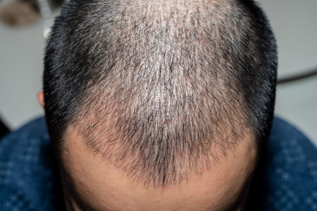 how does hair transplant surgery work