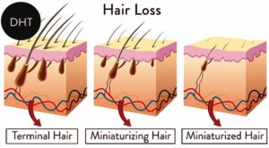 hair loss sm1