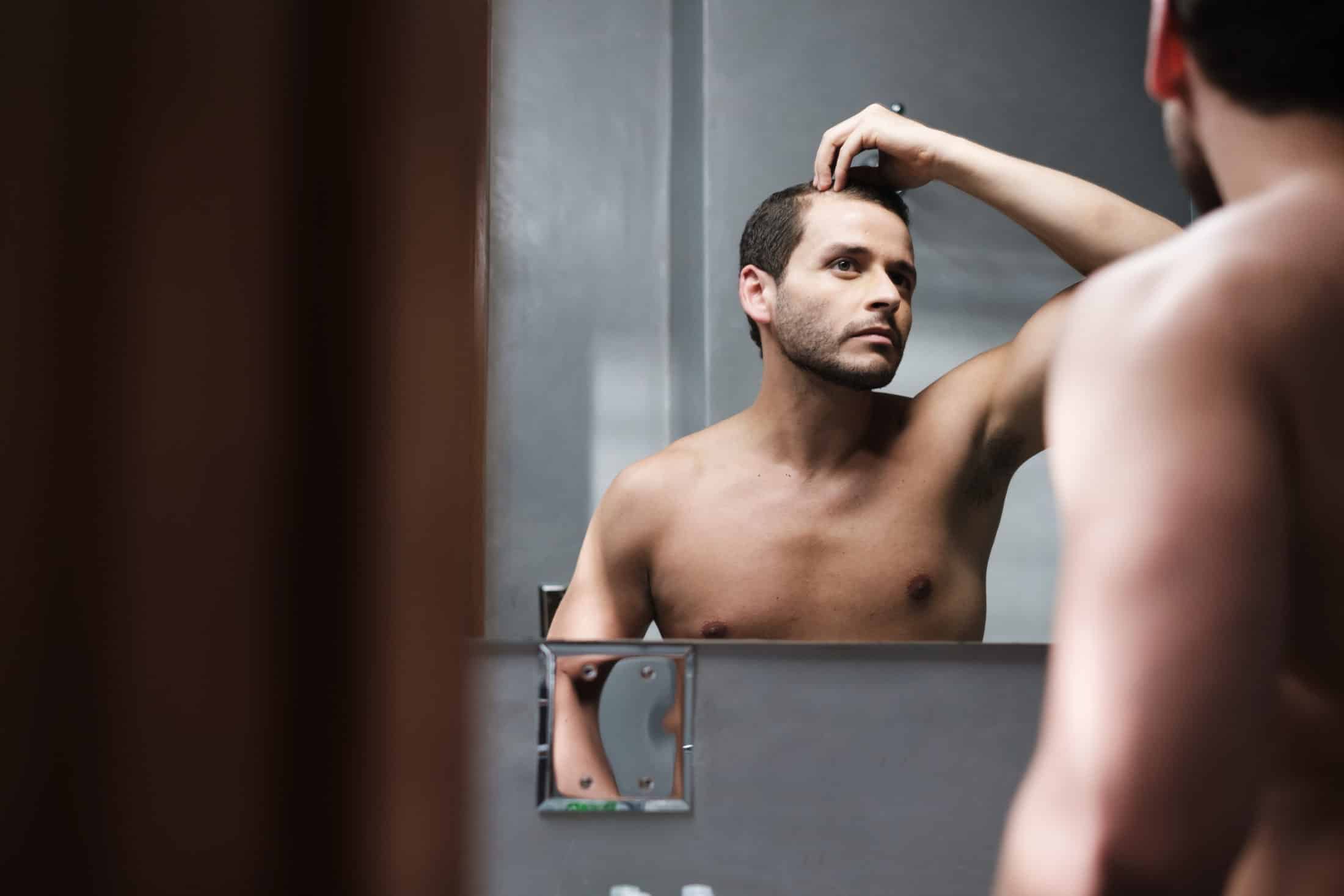 male pattern baldness