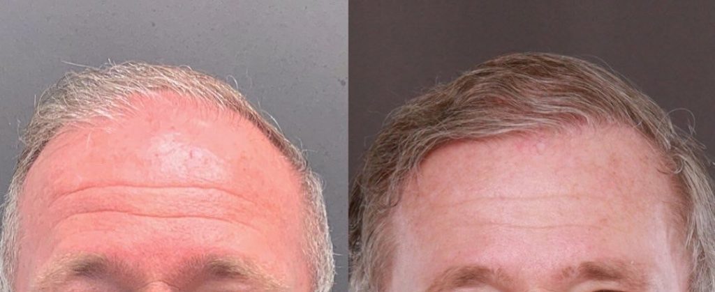 Hair transplant surgery is becoming common
