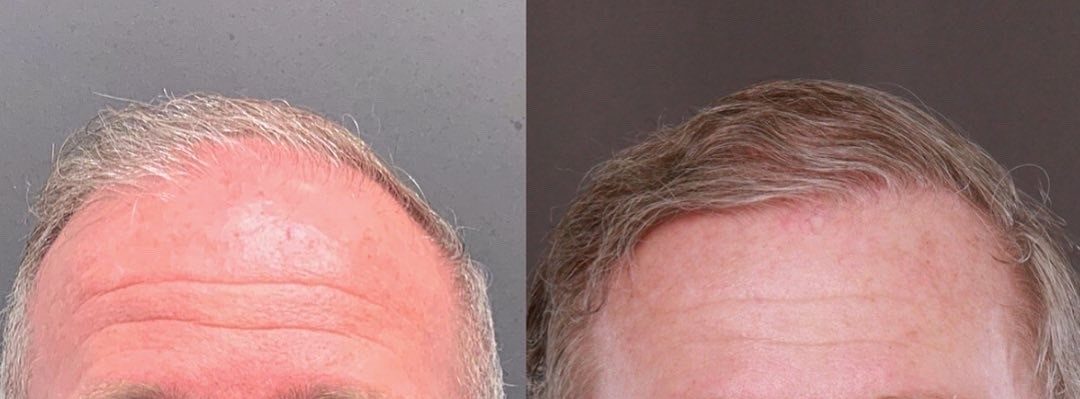Successful Hair Transplant Surgery