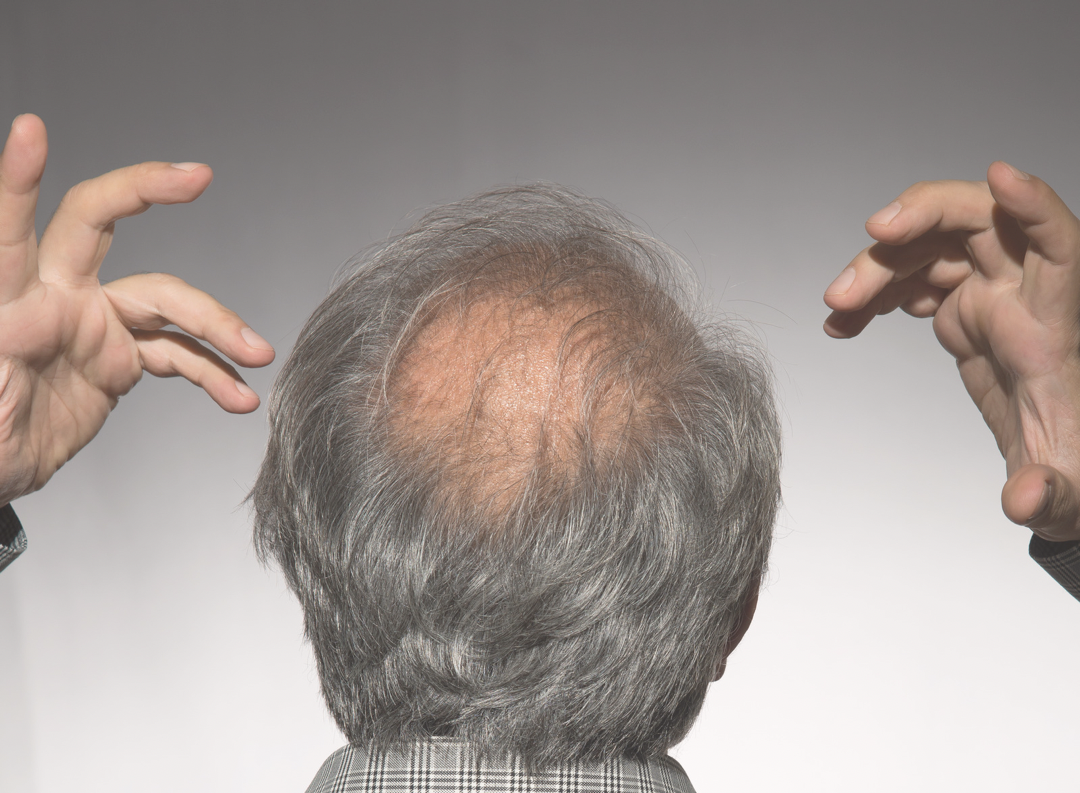 balding
