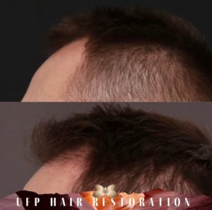 5 reasons to consider a hair transplant