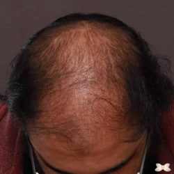 FUT Hair Restoration by: Dr. Thompson