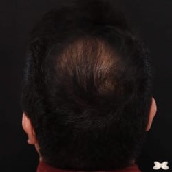 FUT Hair Transplant By: Dr. Thompson