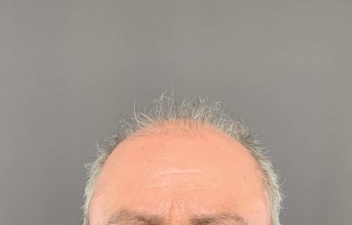 FUE Hair Transplant by Dr. Henstrom