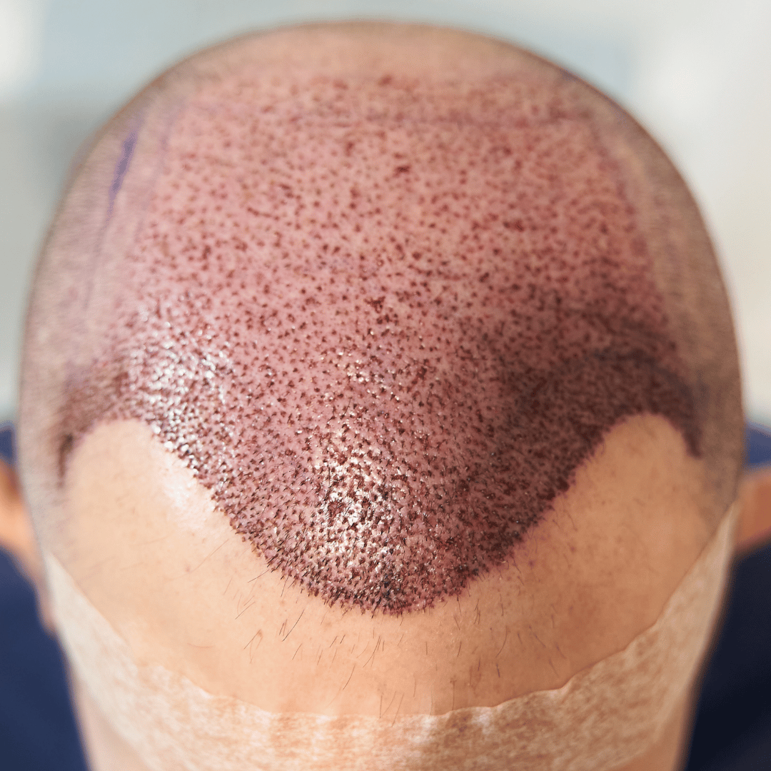 after hair transplant