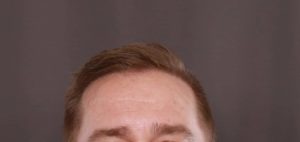 FUE Hair Transplant by Dr. Thompson