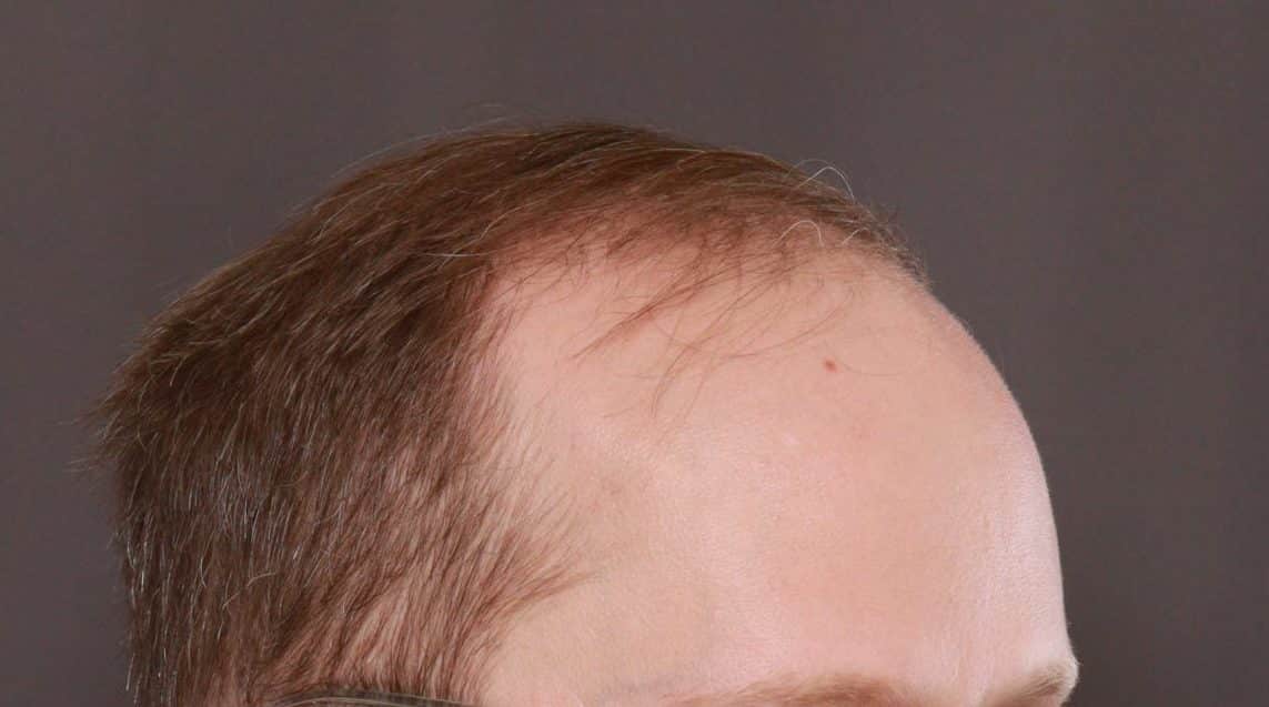 Before Image: FUE Hair Transplant by Dr. Henstrom -