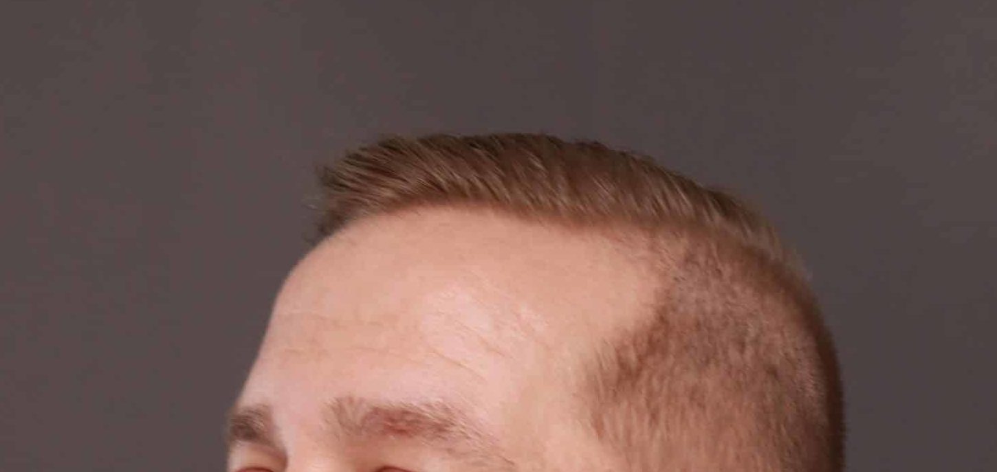 Before Image: FUE Hair Transplant by Dr. Thompson - left-front-oblique