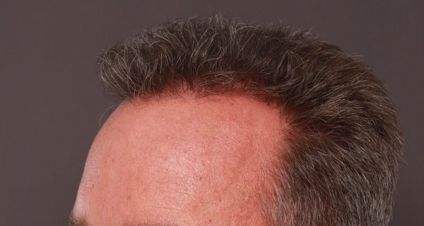 After Image: FUE Hair Transplant by Dr. Thompson - left-front-oblique