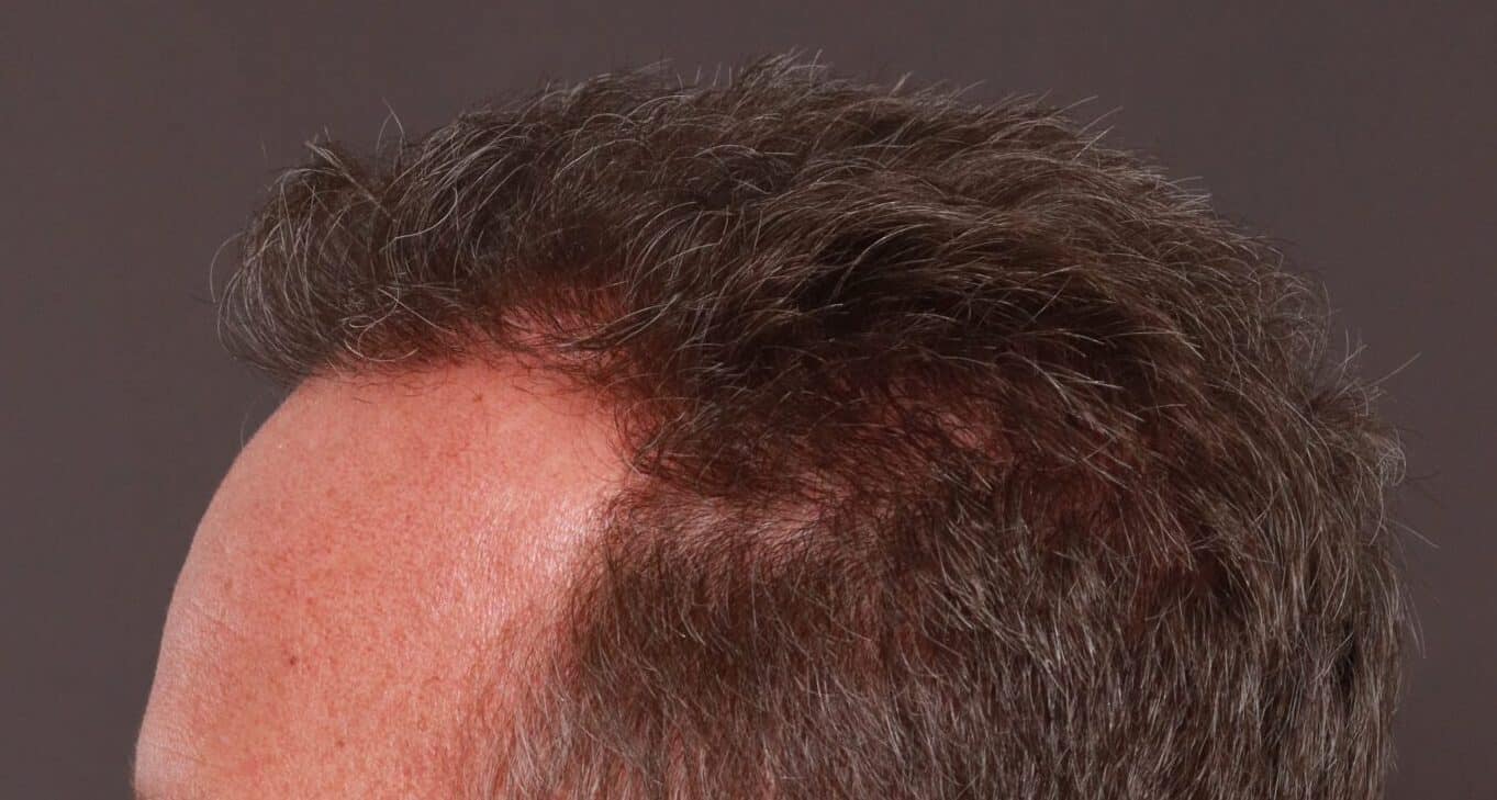 After Image: FUE Hair Transplant by Dr. Thompson - left-side