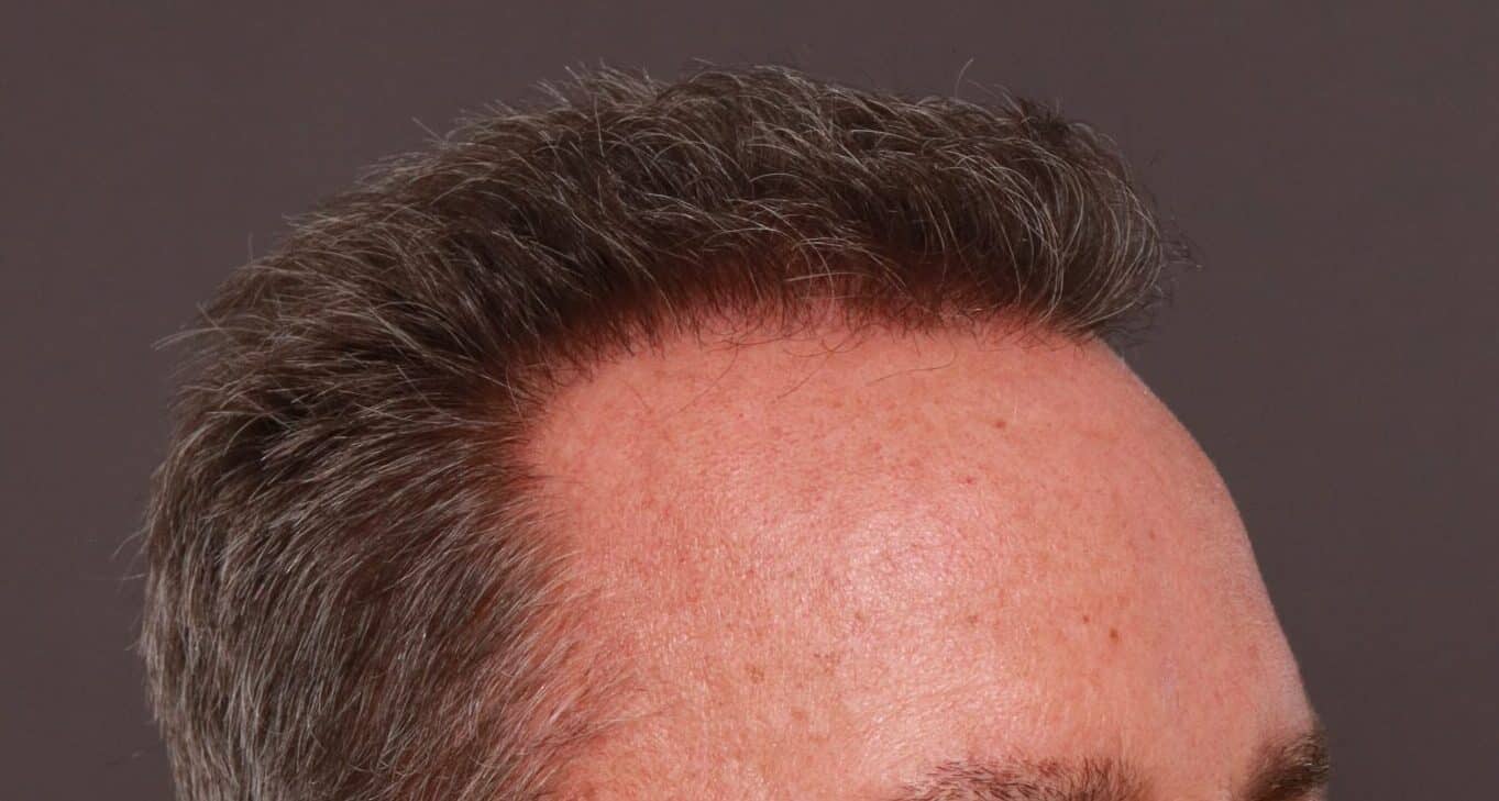 After Image: FUE Hair Transplant by Dr. Thompson - right-front-oblique