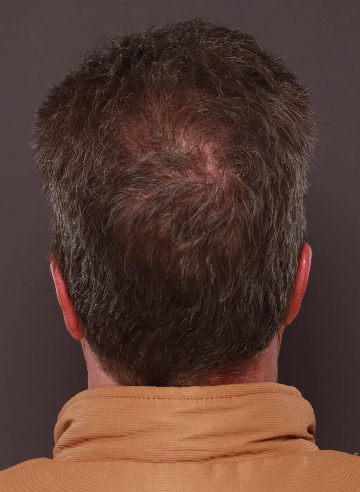 After Image: FUE Hair Transplant by Dr. Thompson - back