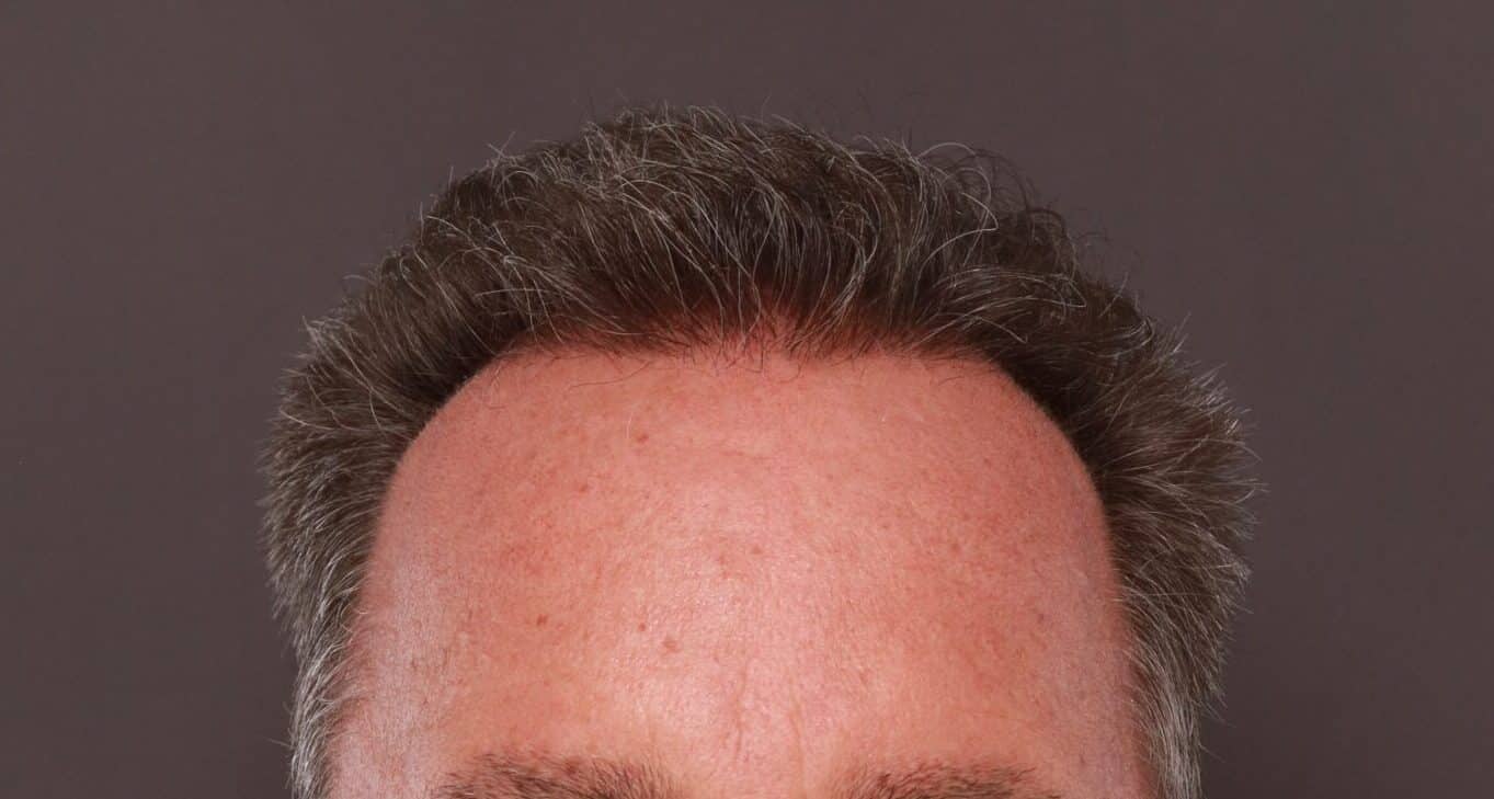 After Image: FUE Hair Transplant by Dr. Thompson - front