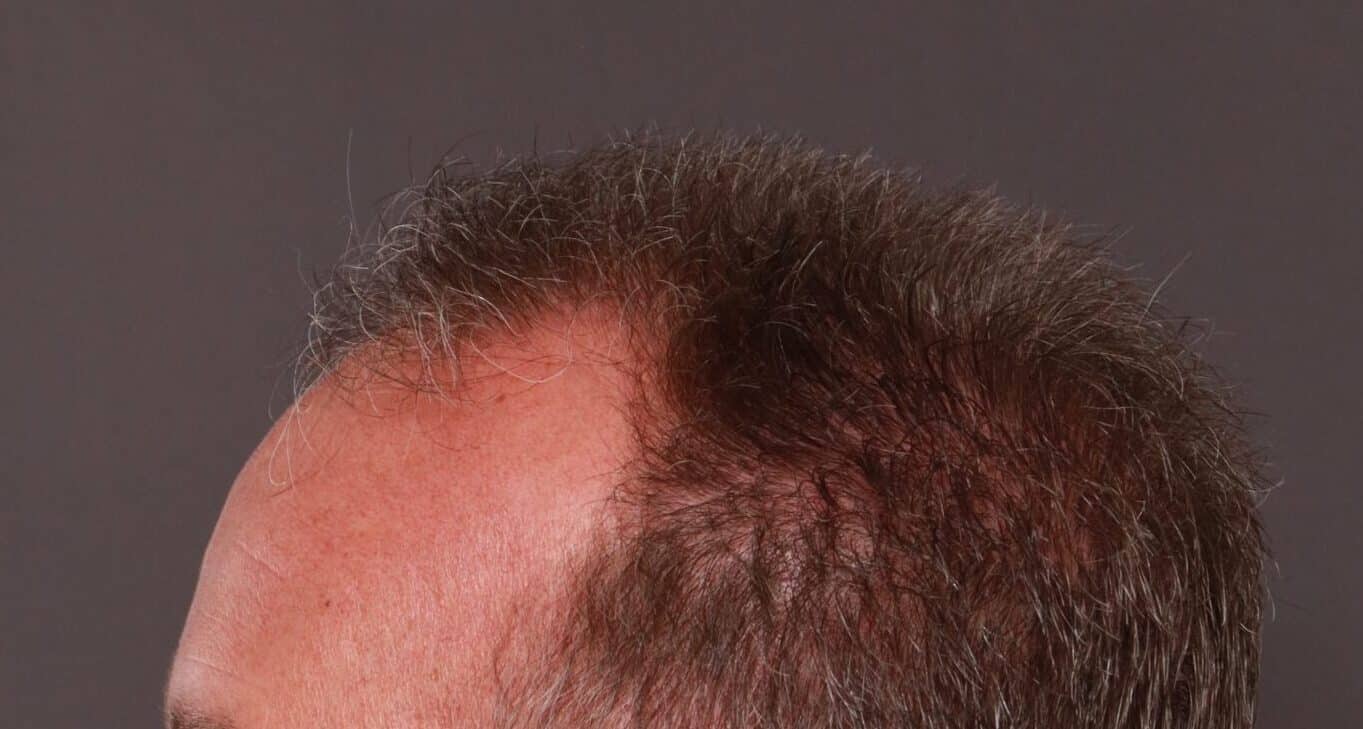 Before Image: FUE Hair Transplant by Dr. Thompson - left-side