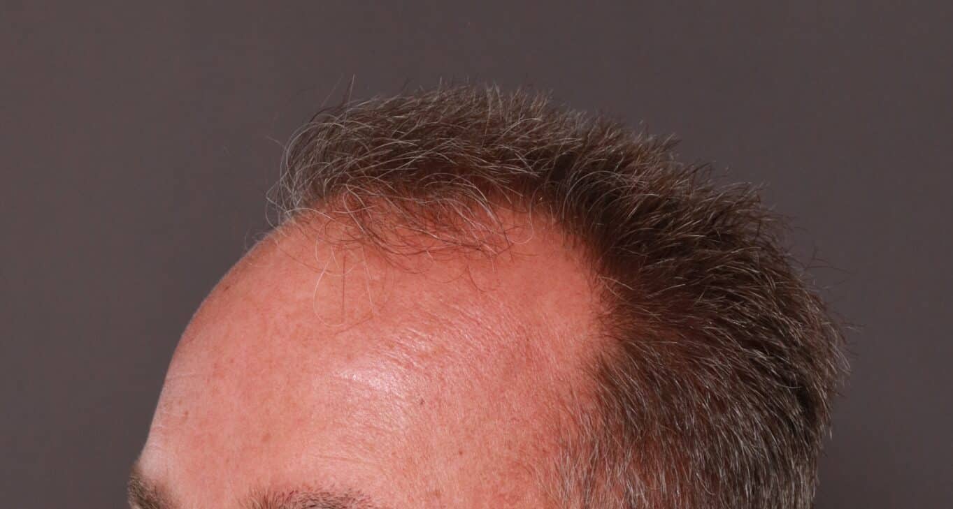 Before Image: FUE Hair Transplant by Dr. Thompson - left-front-oblique