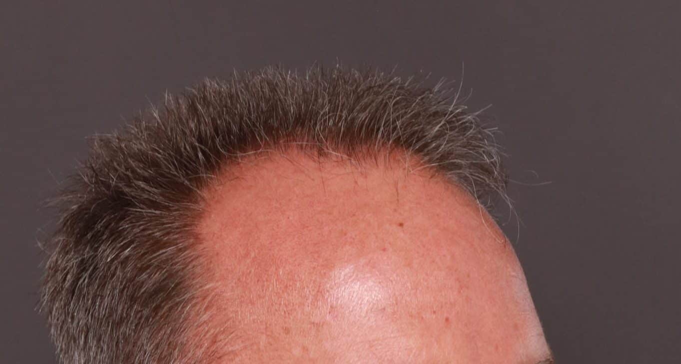 Before Image: FUE Hair Transplant by Dr. Thompson - right-front-oblique