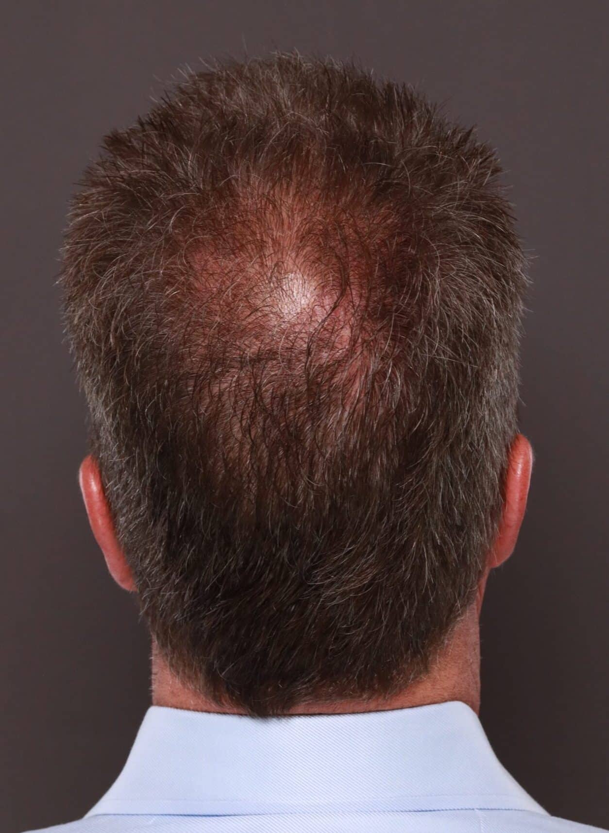 Before Image: FUE Hair Transplant by Dr. Thompson - back