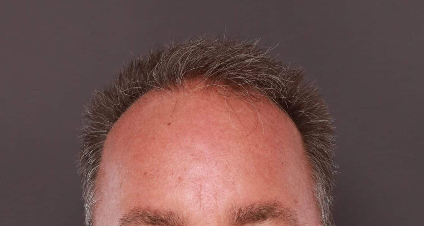 Before Image: FUE Hair Transplant by Dr. Thompson - front