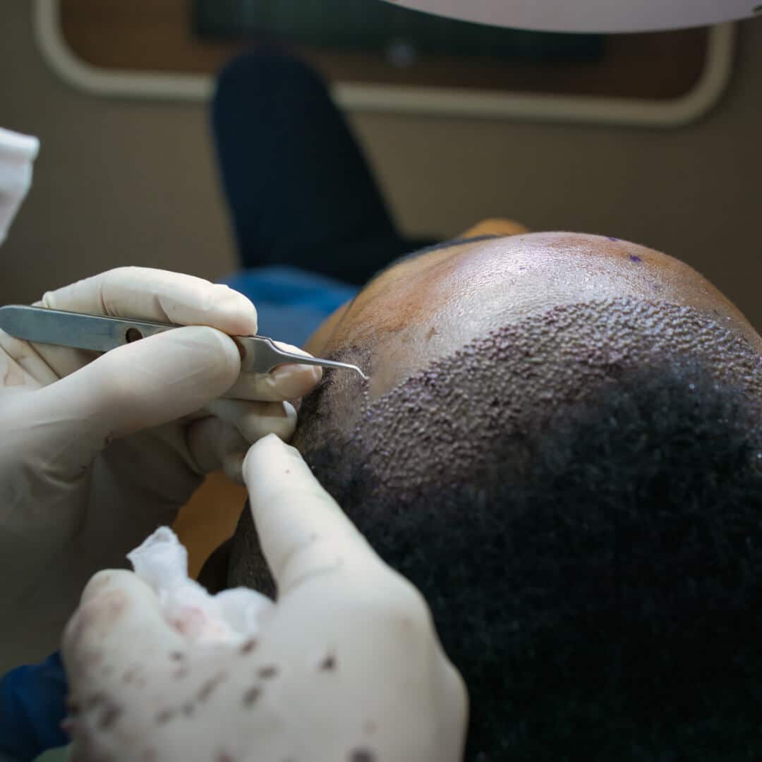 Turkey hair transplant