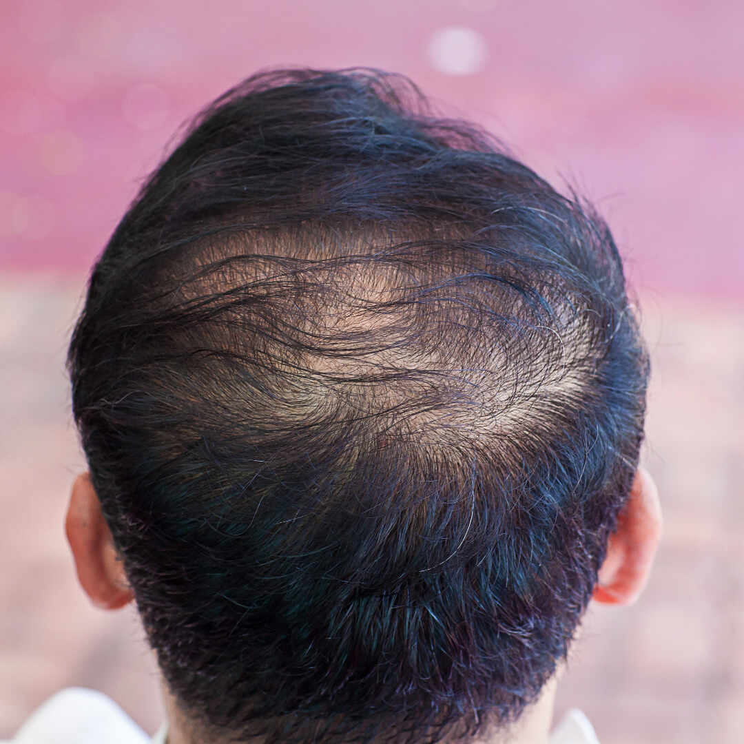 What Medical Condition Causes Hair Thinning