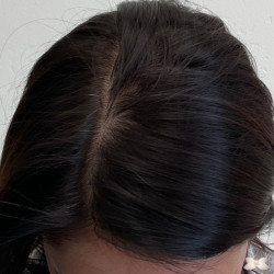 PRP Therapy UFP Hair Restoration Salt Lake City