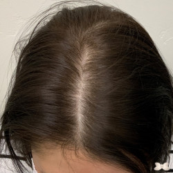 PRP Therapy UFP Hair Restoration Salt Lake City