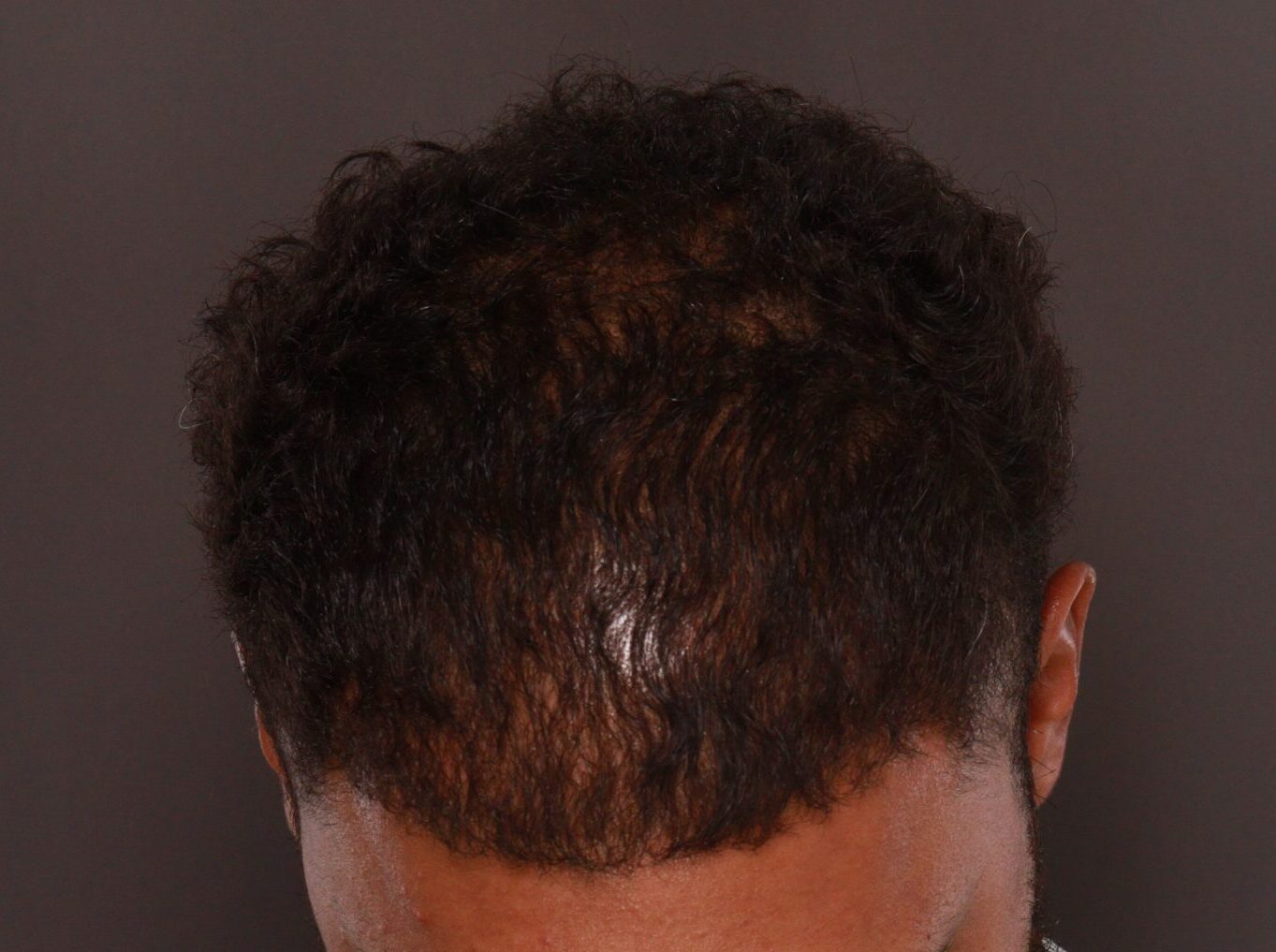 After Image: FUE Hair Transplant by Dr. Manning - front