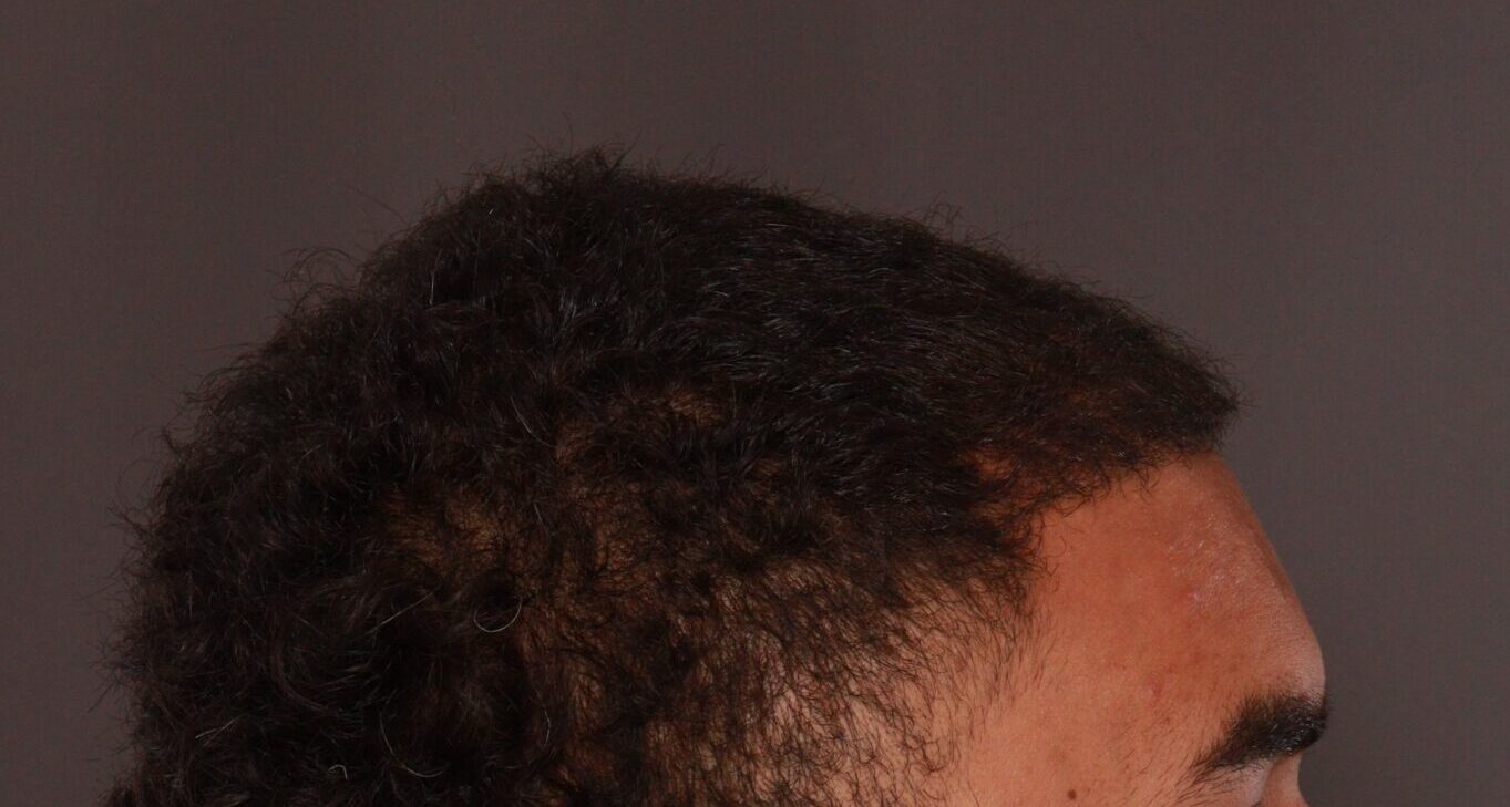 After Image: FUE Hair Transplant by Dr. Manning - right-side