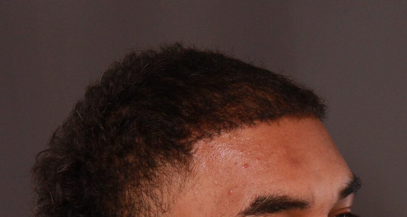 After Image: FUE Hair Transplant by Dr. Manning - right-front-oblique