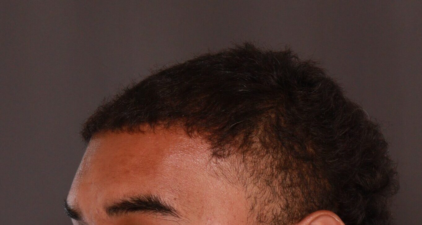 After Image: FUE Hair Transplant by Dr. Manning - left-front-oblique