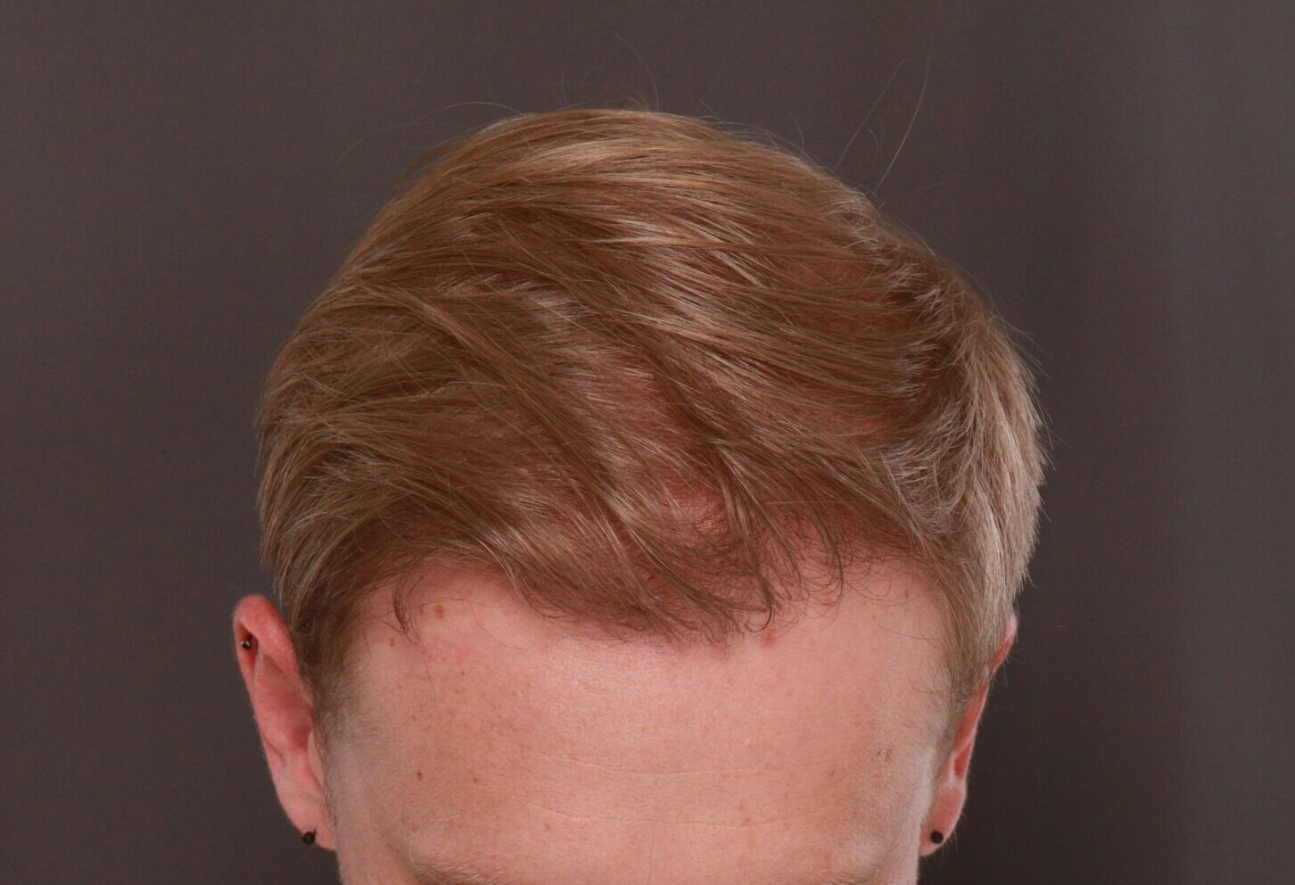 After Image: FUE Hair Transplant by Dr. Henstrom - front
