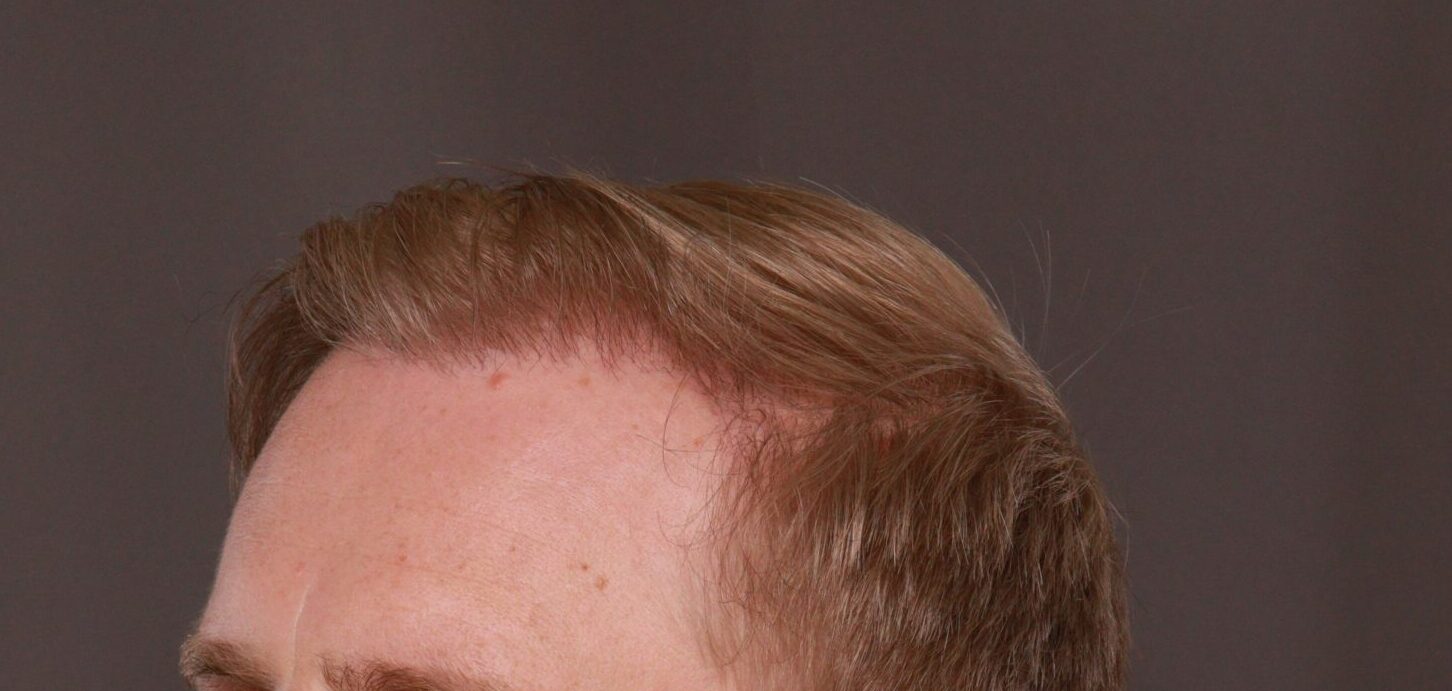 After Image: FUE Hair Transplant by Dr. Henstrom - left-front-oblique