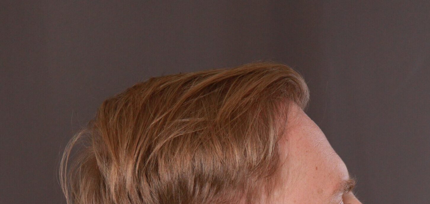 After Image: FUE Hair Transplant by Dr. Henstrom -