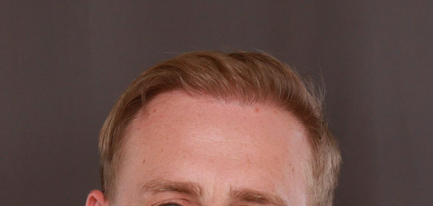 After Image: FUE Hair Transplant by Dr. Henstrom - front