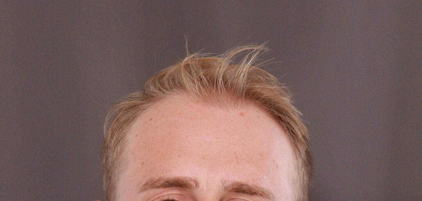 Before Image: FUE Hair Transplant by Dr. Henstrom - front