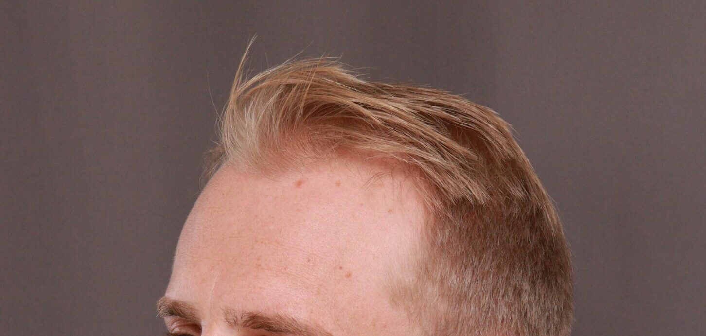 Before Image: FUE Hair Transplant by Dr. Henstrom - left-front-oblique