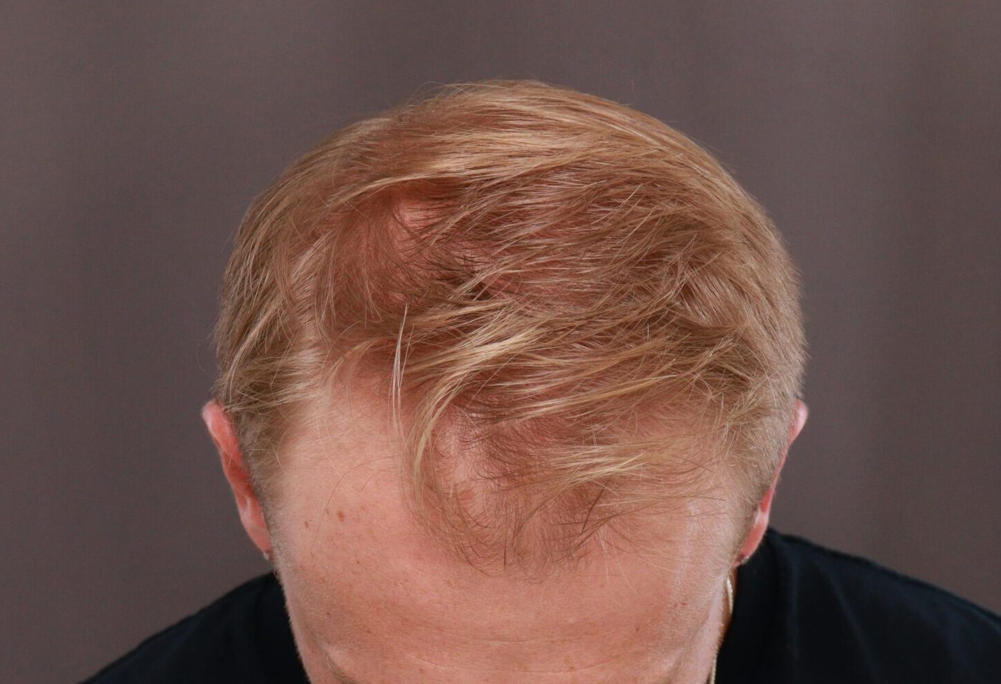 Before Image: FUE Hair Transplant by Dr. Henstrom - front