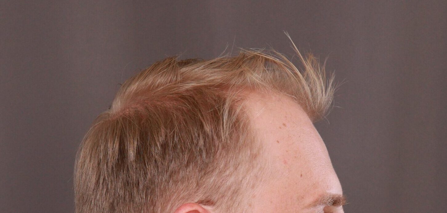 Before Image: FUE Hair Transplant by Dr. Henstrom -