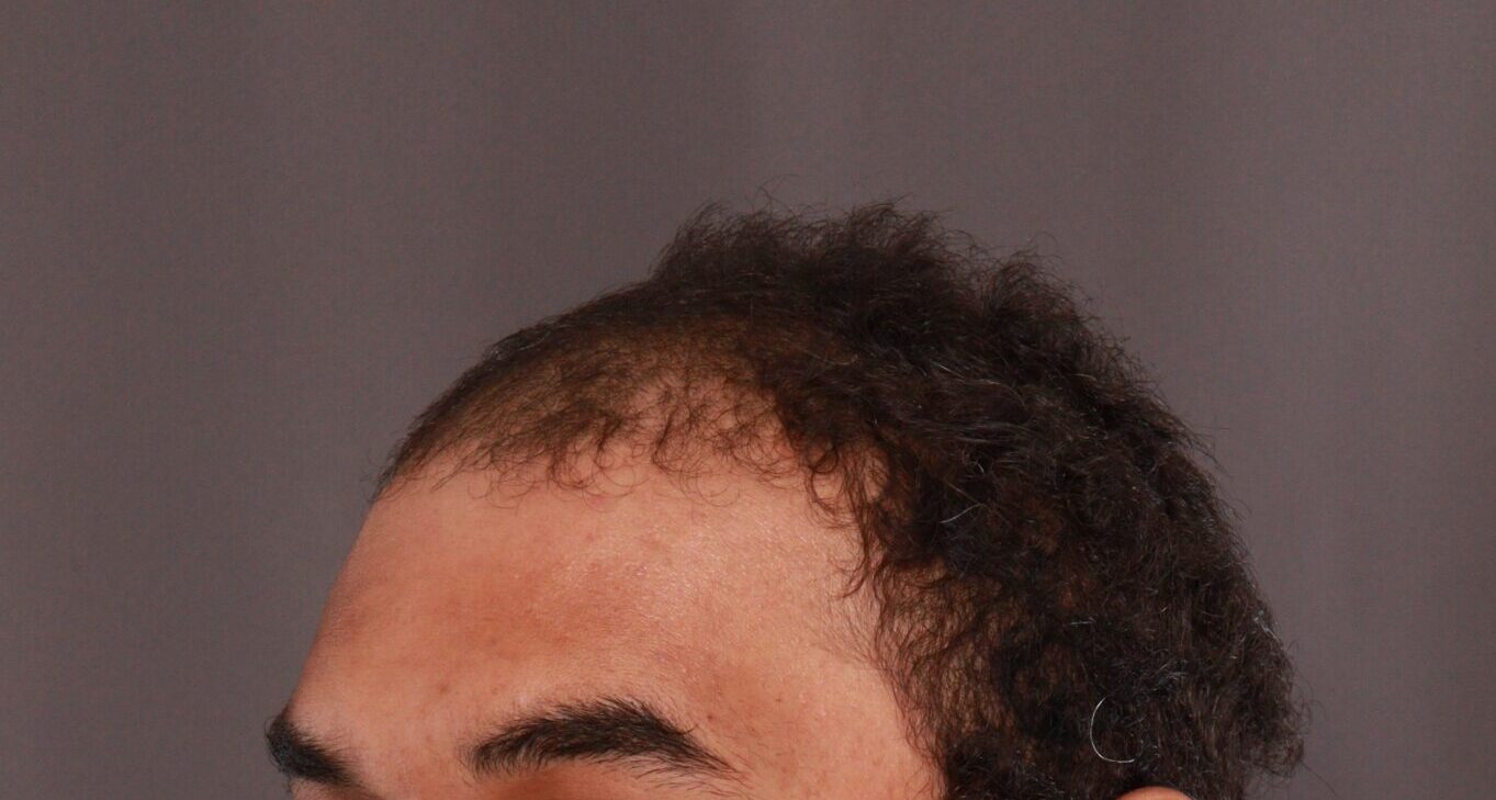 Before Image: FUE Hair Transplant by Dr. Manning - left-front-oblique