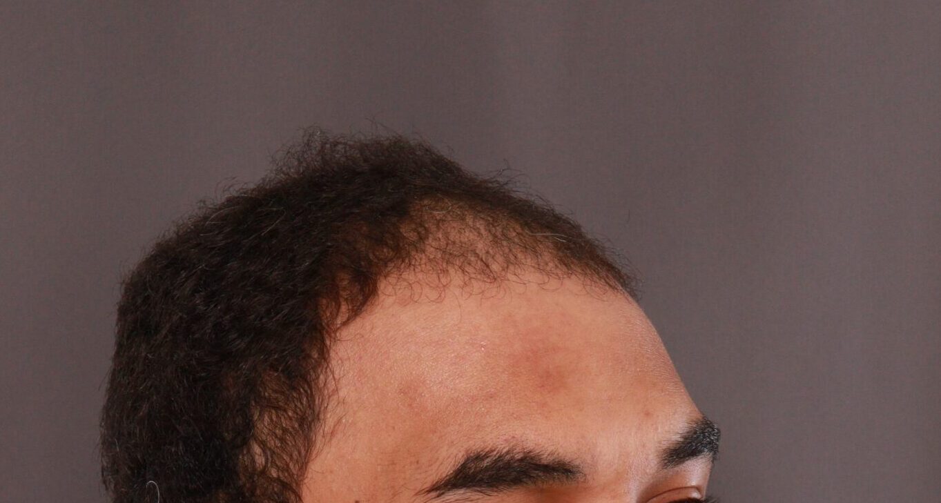 Before Image: FUE Hair Transplant by Dr. Manning - right-front-oblique