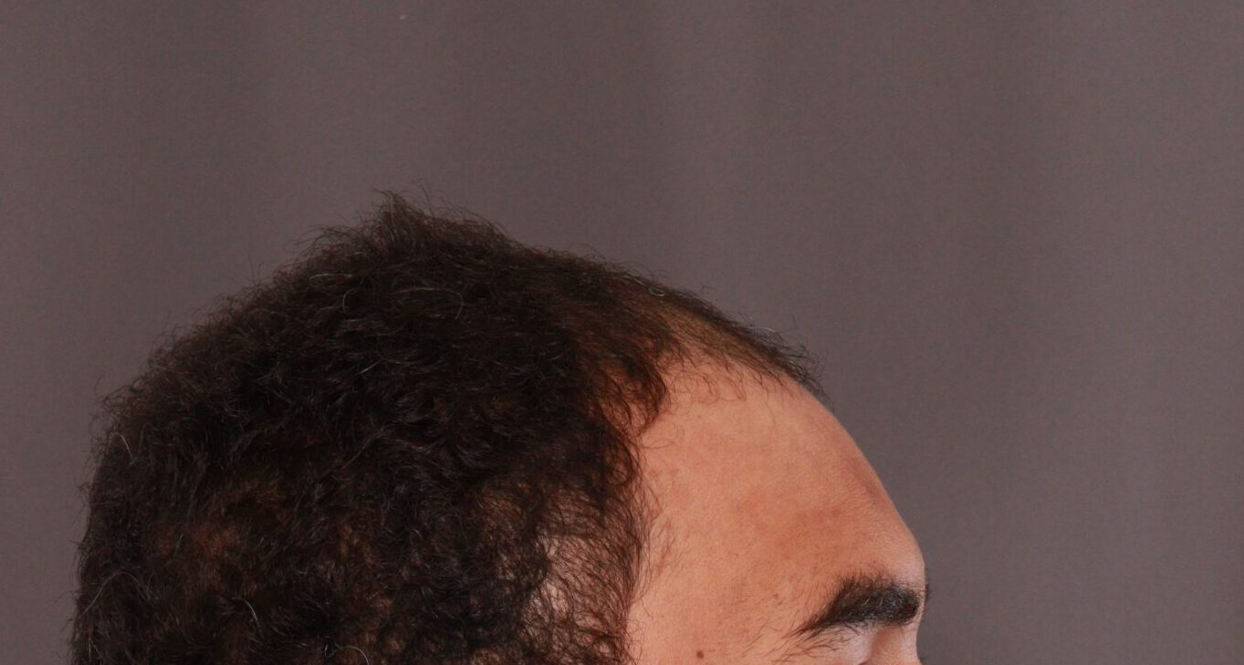 Before Image: FUE Hair Transplant by Dr. Manning - right-side