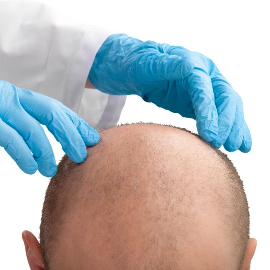 What Treatments Are Available For Hair Restoration?