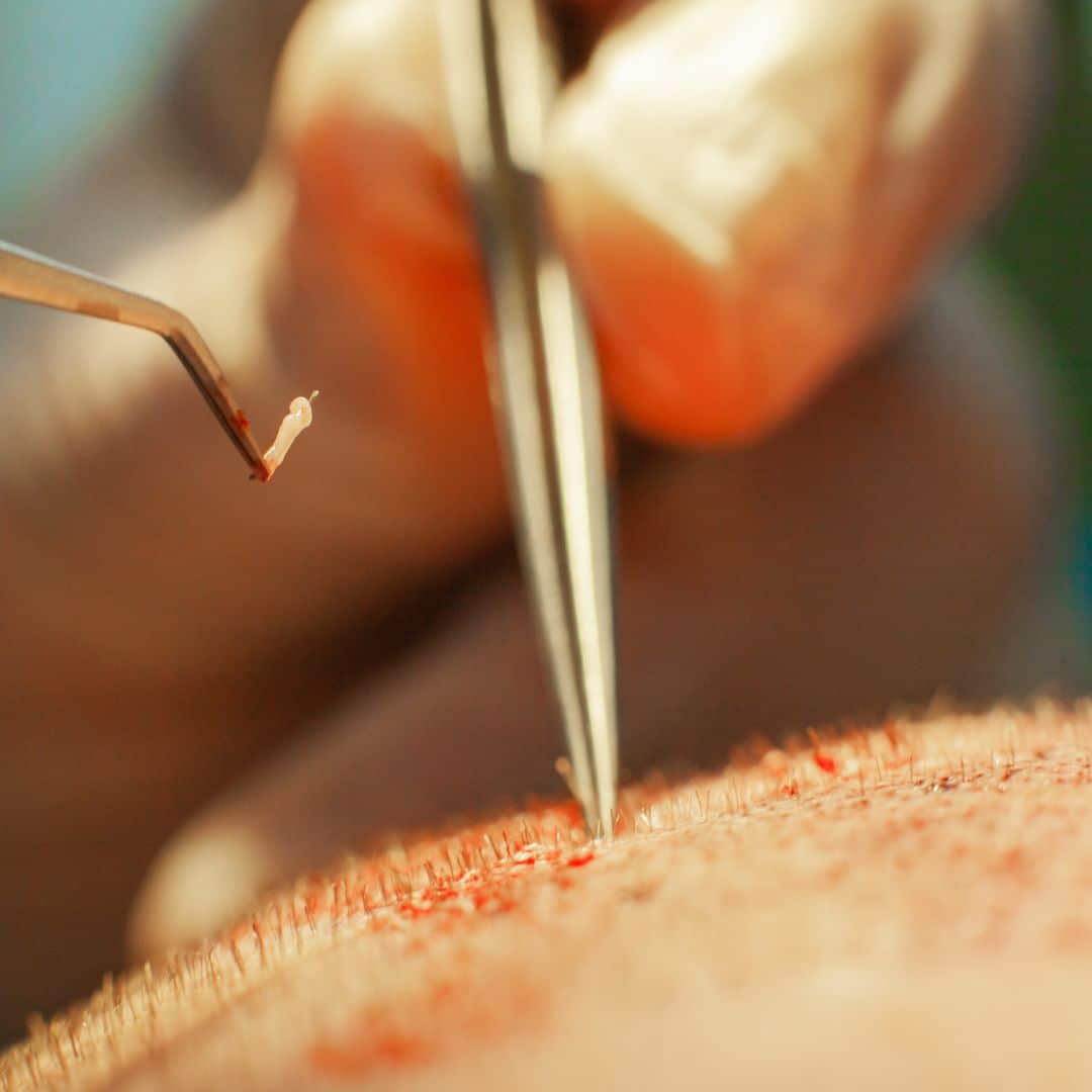 Hair Plugs 101 What They Are and How Realistic Do They Look? Utah